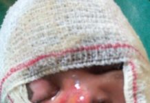 Mother Makes SOS call for 3-year-old Severely Burnt Child