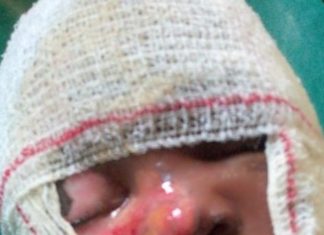 Mother Makes SOS call for 3-year-old Severely Burnt Child