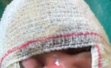 Mother Makes SOS call for 3-year-old Severely Burnt Child