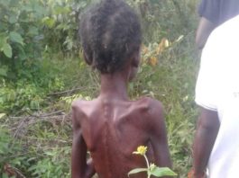 SOS call for 15-Year-Old girl ill-treated for alleged Witch in Nimba County