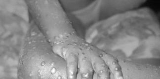 Liberia confirms four cases of Mpox