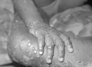 WHO Declares Monkeypox ‘Public Health emergency’
