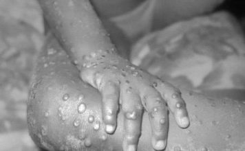 Liberia records three new Cases of Mpox