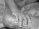 WHO Declares Monkeypox ‘Public Health emergency’